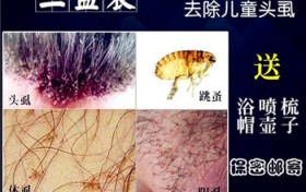 去虱子卵最简单的方法？小孩有头虱子怎么去除？用风油精去虱子卵最简单的方法？